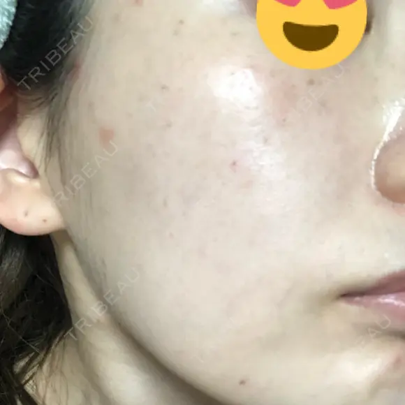 美肌レーザー / シミ取りレーザー たかはし形成外科･美容外科  DAY 5 メイン用