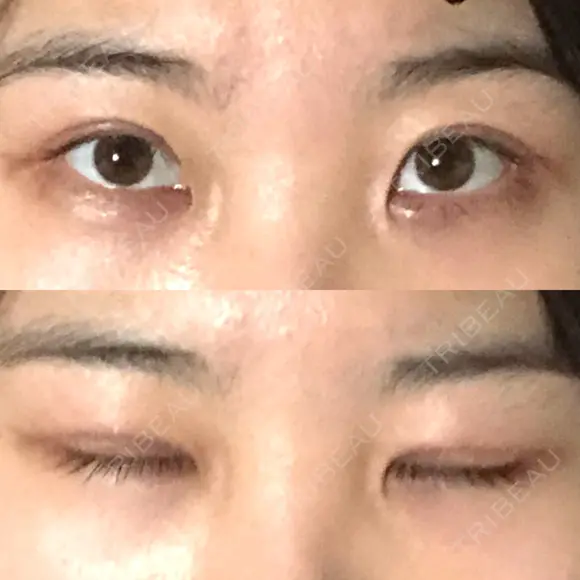 二重切開 / 眼瞼下垂（切開） ブリスクリニック形成外科・美容外科・美容皮膚科 福岡 DAY 8 メイン用