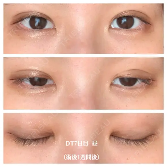 二重埋没 湘南美容クリニック 藤沢院 DAY 7 メイン用