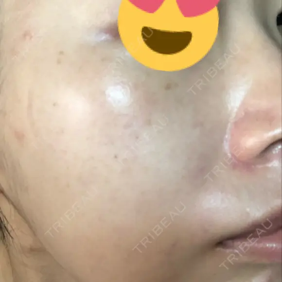 美肌レーザー / シミ取りレーザー たかはし形成外科･美容外科  AFTER メイン用