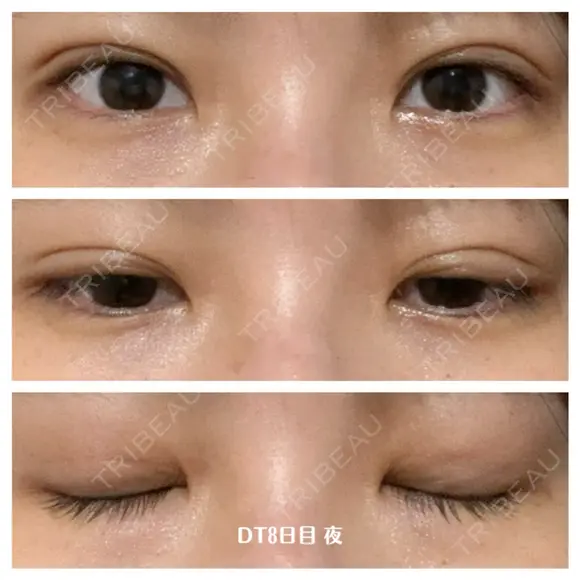 二重埋没 湘南美容クリニック 藤沢院 DAY 8 メイン用