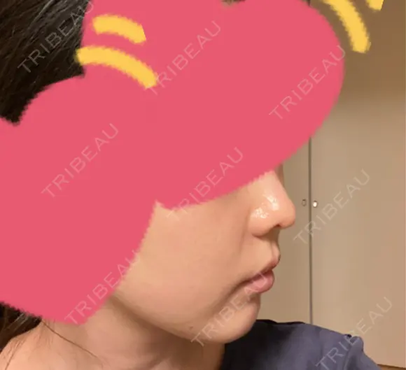 小鼻縮小（切開） / 鼻翼基部形成（貴族手術） 新宿ラクル美容外科クリニック 新宿院 DAY 64 メイン用