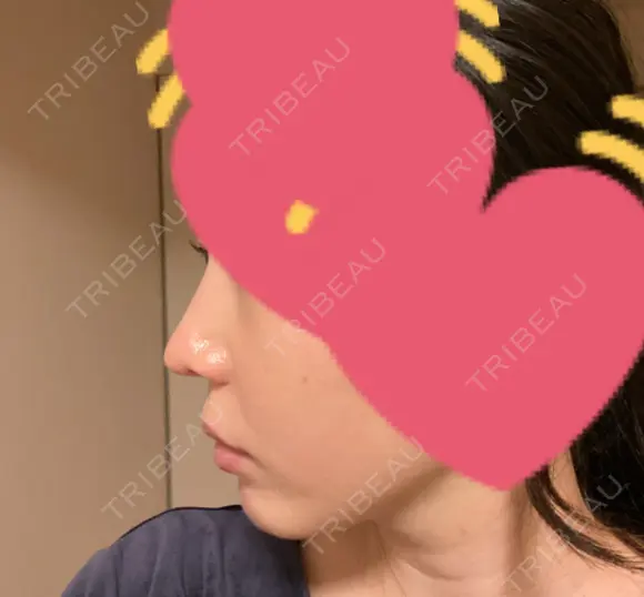 小鼻縮小（切開） / 鼻翼基部形成（貴族手術） 新宿ラクル美容外科クリニック 新宿院 DAY 64 メイン用