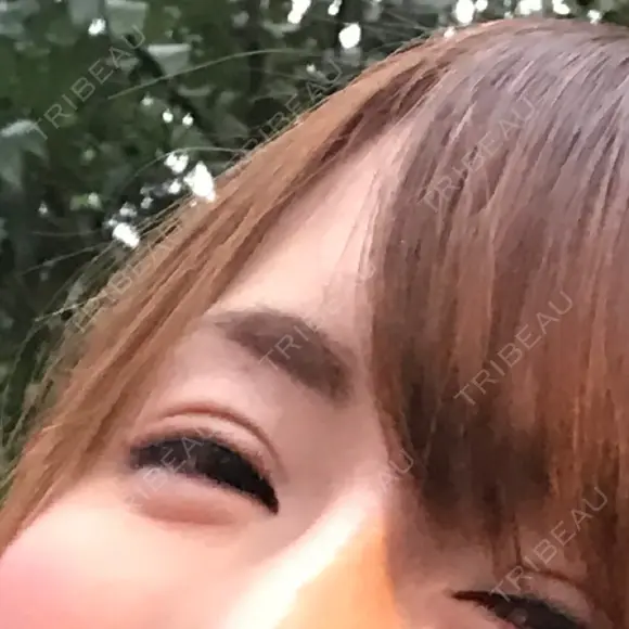 二重切開 高須クリニック 名古屋院 DAY 38 メイン用