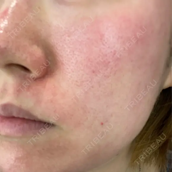 ピーリング（ニキビ・毛穴） / ダーマペン Zetith Beauty Clinic 銀座院 DAY 0 メイン用