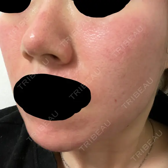 ピーリング（ニキビ・毛穴） / ダーマペン Zetith Beauty Clinic 銀座院 DAY 1 メイン用