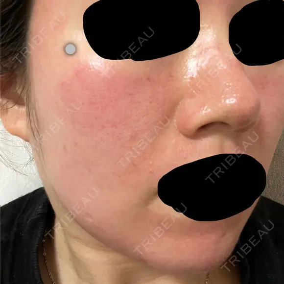 ピーリング（ニキビ・毛穴） / ダーマペン Zetith Beauty Clinic 銀座院 DAY 1 メイン用