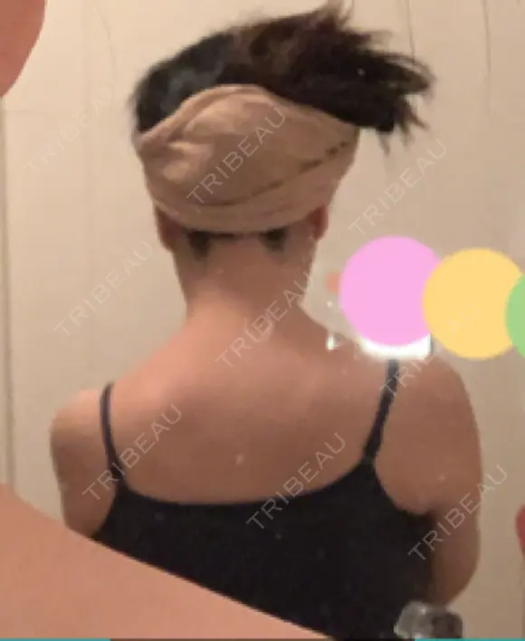 ボトックス（肩） 湘南美容クリニック 藤沢院 DAY 7 メイン用