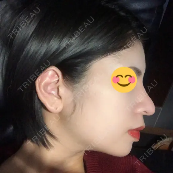 隆鼻術 / 鼻尖形成（切開） / 鼻中隔延長（切開） / 骨切幅寄せ 表参道スキンクリニック 表参道院 DAY 39 メイン用