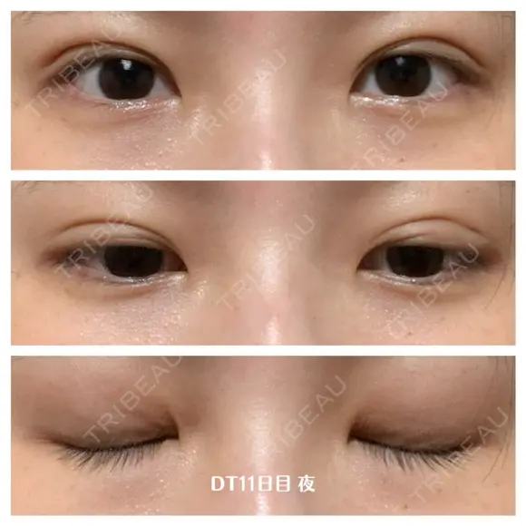 二重埋没 湘南美容クリニック 藤沢院 DAY 11 メイン用