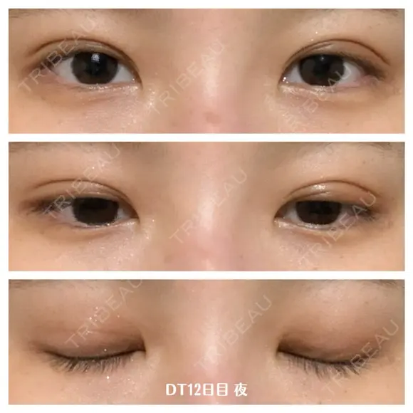 二重埋没 湘南美容クリニック 藤沢院 DAY 12 メイン用