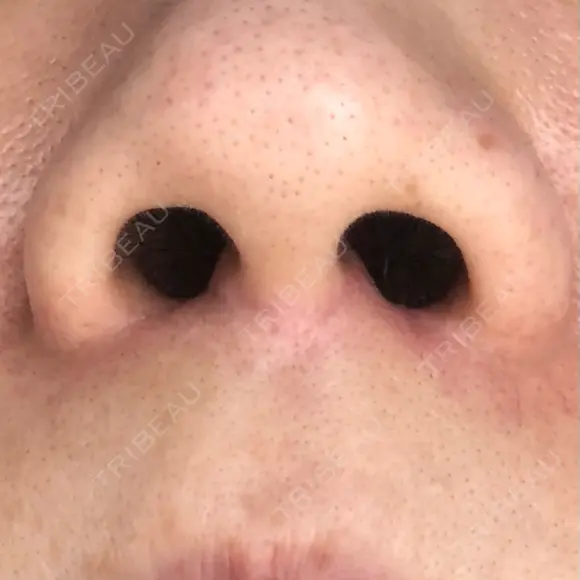 人中短縮 藤・ナチュレ美容クリニック 恵比寿院 DAY 151 メイン用