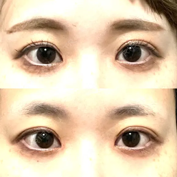 目頭切開 聖心美容クリニック 横浜院 DAY 18 メイン用