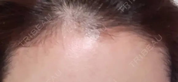アートメイク（ヘアライン） トイトイトイクリニック 池袋院 AFTER メイン用