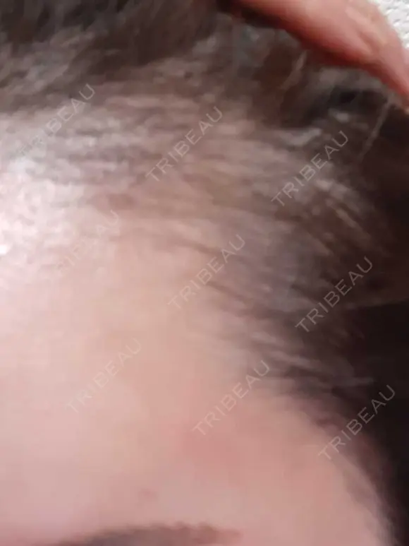 アートメイク（ヘアライン） トイトイトイクリニック 池袋院 DAY 68 メイン用