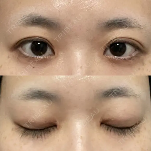 目頭切開 聖心美容クリニック 横浜院 DAY 19 メイン用
