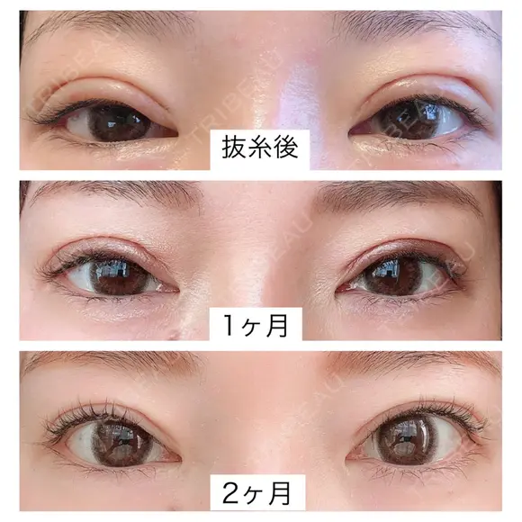 二重切開 北尾クリニック DAY 59 メイン用