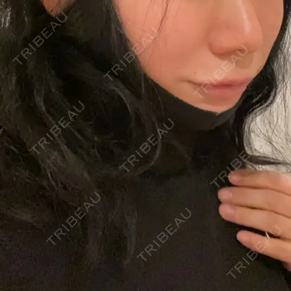 切開リフト / ボトックス（エラ・小顔） 石倉クリニック 水戸院 DAY 0 メイン用