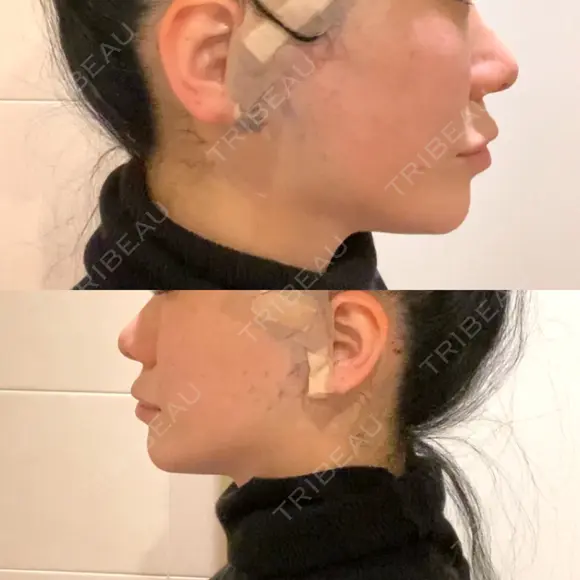 切開リフト / ボトックス（エラ・小顔） 石倉クリニック 水戸院 DAY 0 メイン用