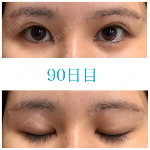 上まぶたの脂肪取り / 眉下切開 JUN CLINIC DAY 90 メイン用