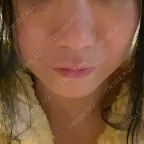 切開リフト / ボトックス（エラ・小顔） 石倉クリニック 水戸院 DAY 5 メイン用