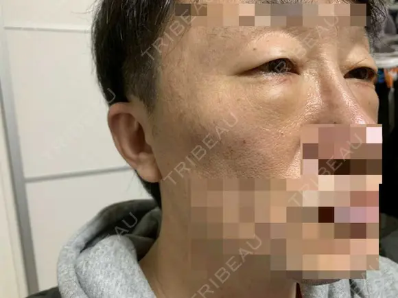 眼瞼下垂（切開） 湘南美容クリニック 船橋院 DAY 3 メイン用