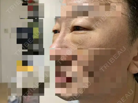 眼瞼下垂（切開） 湘南美容クリニック 船橋院 DAY 4 メイン用