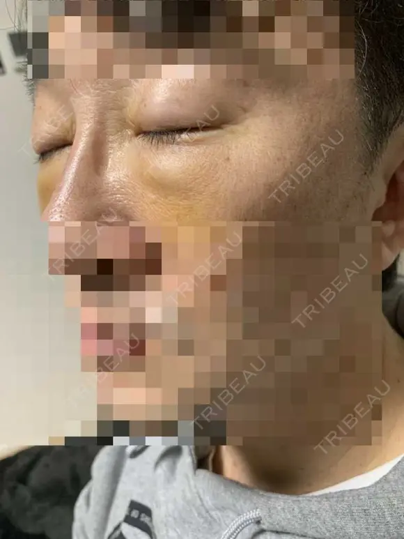 眼瞼下垂（切開） 湘南美容クリニック 船橋院 DAY 6 メイン用