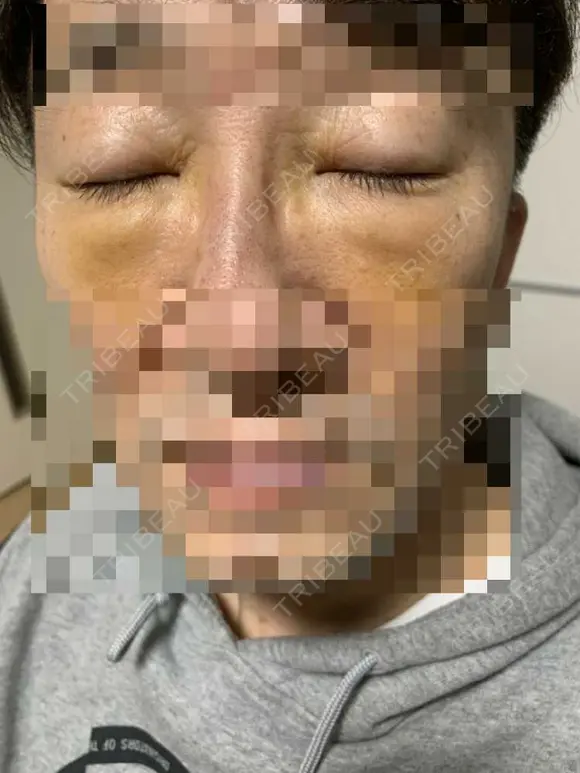 眼瞼下垂（切開） 湘南美容クリニック 船橋院 DAY 6 メイン用