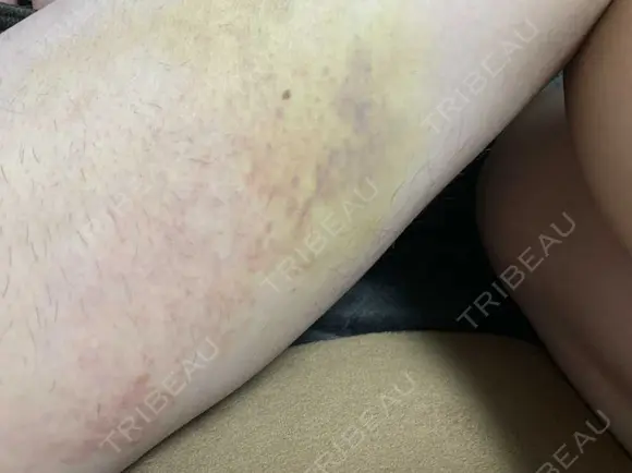 眼瞼下垂（切開） 湘南美容クリニック 船橋院 DAY 6 メイン用