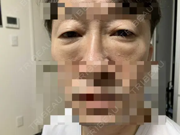 眼瞼下垂（切開） 湘南美容クリニック 船橋院 DAY 10 メイン用
