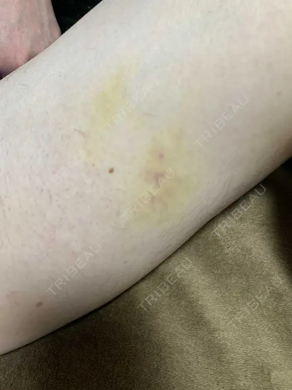 眼瞼下垂（切開） 湘南美容クリニック 船橋院 DAY 10 メイン用