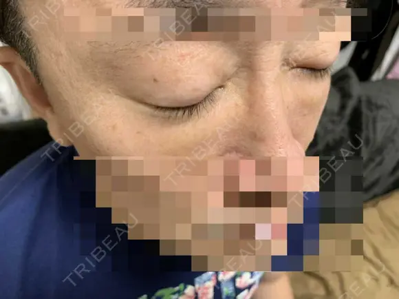 眼瞼下垂（切開） 湘南美容クリニック 船橋院 AFTER メイン用