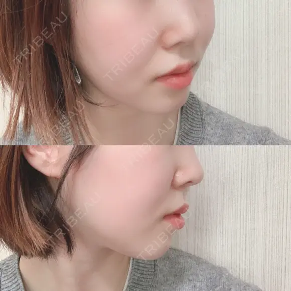 骨切り（あご） / 骨削り（エラ） / 骨削り（頬） id（アイディ）美容外科 DAY 336 メイン用