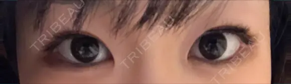 二重埋没 / 上まぶたの脂肪取り TCB東京中央美容外科 江坂院 AFTER メイン用