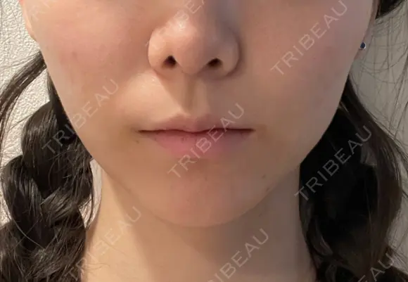 脂肪吸引（顔） Mods Clinic（モッズクリニック） 東京院 DAY 3 メイン用