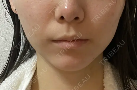 脂肪吸引（顔） Mods Clinic（モッズクリニック） 東京院 DAY 4 メイン用