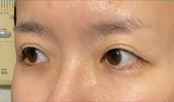 ヒアルロン酸注入（涙袋） 新宿ビューティークリニック 新宿院 DAY 9 メイン用