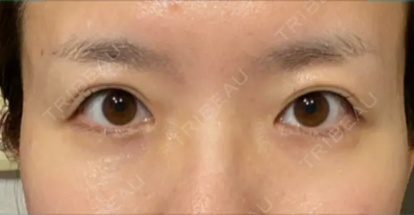 ヒアルロン酸注入（涙袋） 新宿ビューティークリニック 新宿院 DAY 9 メイン用