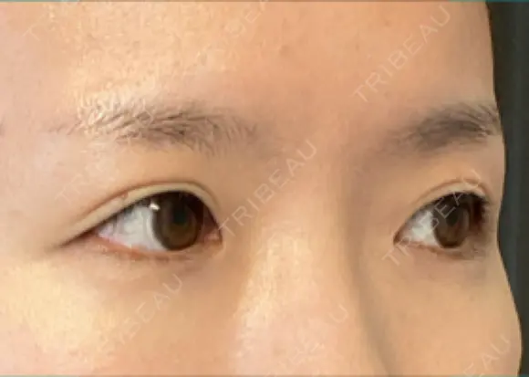 ヒアルロン酸注入（涙袋） 新宿ビューティークリニック 新宿院 DAY 10 メイン用