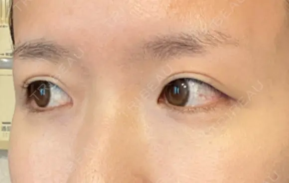 ヒアルロン酸注入（涙袋） 新宿ビューティークリニック 新宿院 DAY 10 メイン用