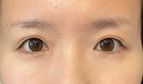 ヒアルロン酸注入（涙袋） 新宿ビューティークリニック 新宿院 DAY 10 メイン用