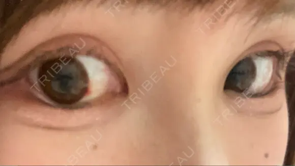 目尻切開 / タレ目形成・グラマラスライン（切開） ビスポーククリニック 福岡院 DAY 19 メイン用