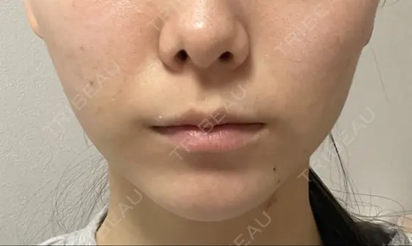 脂肪吸引（顔） Mods Clinic（モッズクリニック） 東京院 DAY 5 メイン用