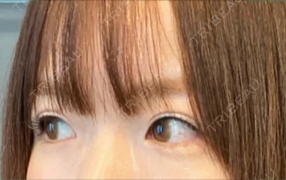 ヒアルロン酸注入（涙袋） 新宿ビューティークリニック 新宿院 DAY 11 メイン用