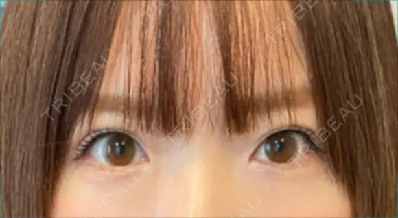 ヒアルロン酸注入（涙袋） 新宿ビューティークリニック 新宿院 AFTER メイン用