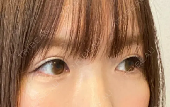 ヒアルロン酸注入（涙袋） 新宿ビューティークリニック 新宿院 DAY 11 メイン用