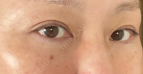 下まぶたたるみ取り / 下まぶたの脂肪取り ヨーダー公子クリニック眼科・美容皮膚科 横浜六浦院 DAY 90 メイン用