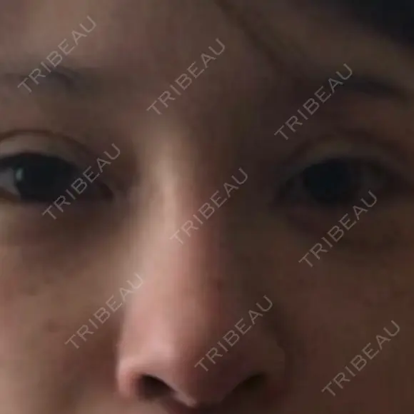 二重切開 / 隆鼻術 / 鼻中隔延長（切開） 牧野皮膚科形成外科内科医院 美容外科・形成外科・抗加齢医学外来 DAY 74 メイン用