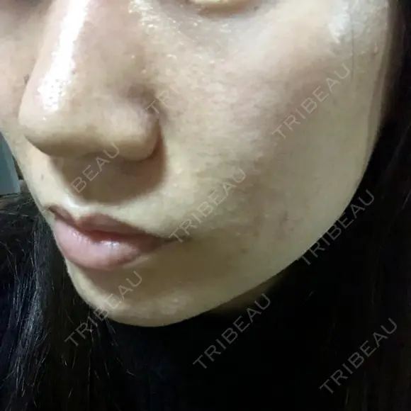ダーマペン えいご皮フ科 奈良院 DAY 17 メイン用